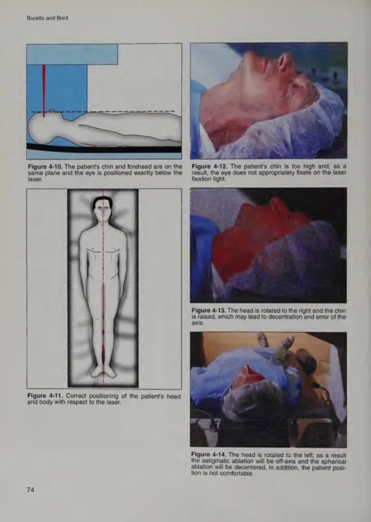 Правильное и неправильное позиционирование пациента при лазерной коррекции