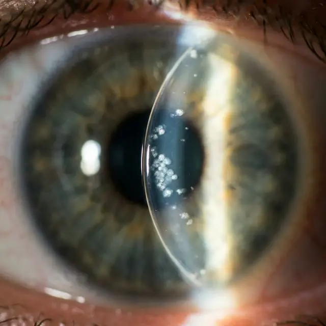 Врастание эпителия под роговичный лоскут после ЛАСИК. Видны белесые островки клеток на щелевой лампе.