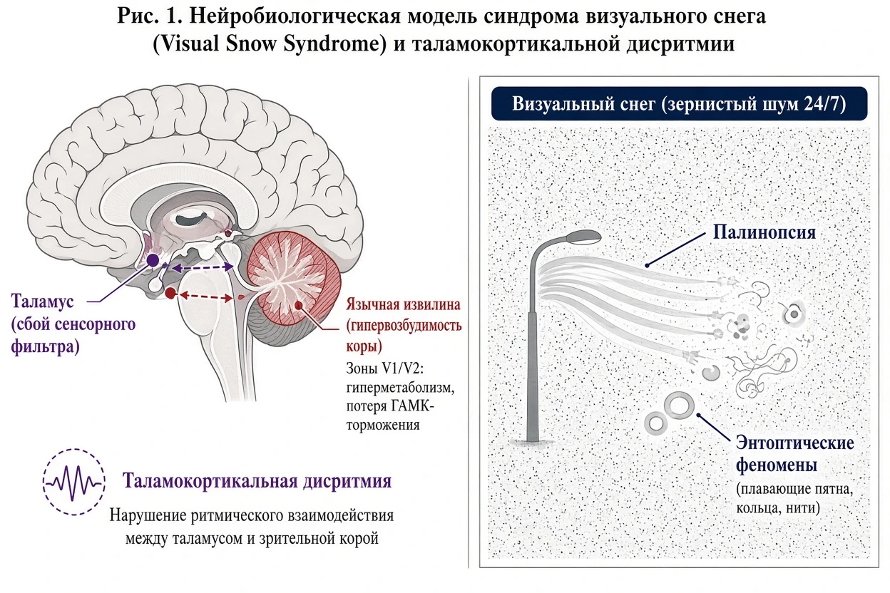 Научная схема нейропатологии Visual Snow Syndrome: таламокортикальная дисритмия и гипервозбудимость язычной извилины