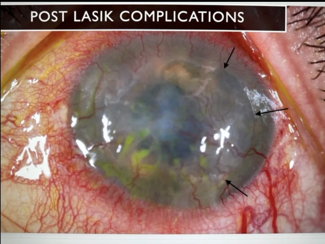 Повреждение глаза после LASIK: роговица непрозрачна, покрыта рубцами, проросли сосуды
