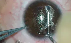 Поврежденные нервы