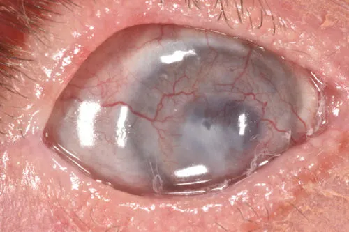 Глаз, ослепший после осложнений LASIK