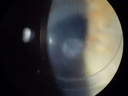 Хейз после ФРК (PRK)