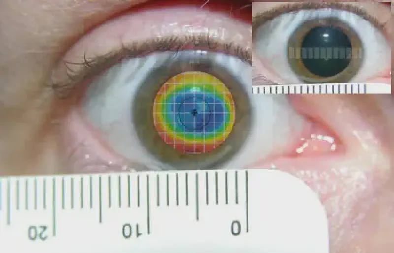 Топография роговицы пациента 2 с большими зрачками после лазерной коррекции