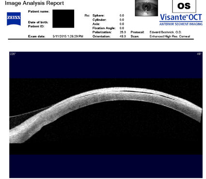lasik flap detachment