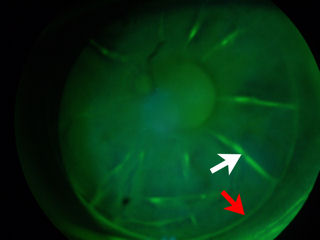 2 RK surgeries followed by LASIK