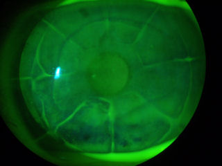 2 RK, 2 LASIK, 2 flap lifts, cataract extraction