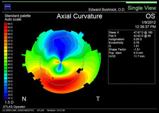 topography 2 RK surgeries followed by LASIK
