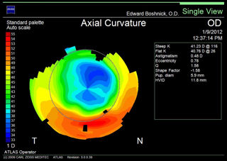 RK twice followed by LASIK topography