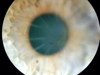 RK incisions into visual axis