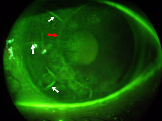 corneal transplant post RK infection