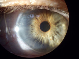 long RK incisions in visual axis