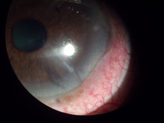 post RK, post LASIK, neovascularization