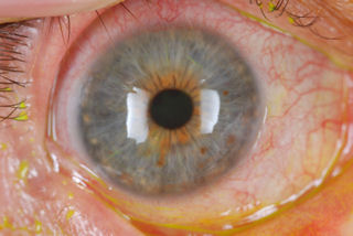 2 RK surgeries followed by 2 LASIK surgeries