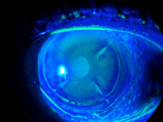2 RK, LASIK, ectasia