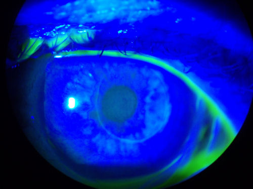 ALK automated lamellar keratoplasty