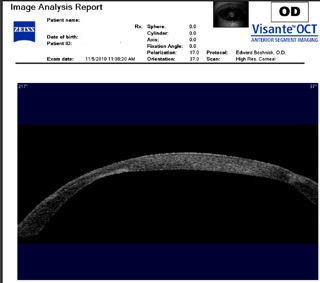 post RK post LASIK ectasia