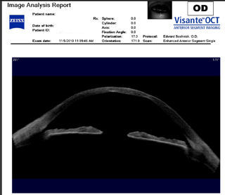 post RK post LASIK ectasia