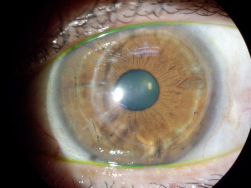 post RK, infection, transplant