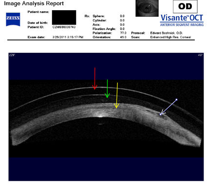 post-LASIK bullous keratopathy