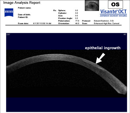 post-lasik epithelial ingrowth
