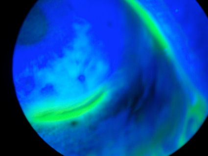 partially dislodged LASIK flap