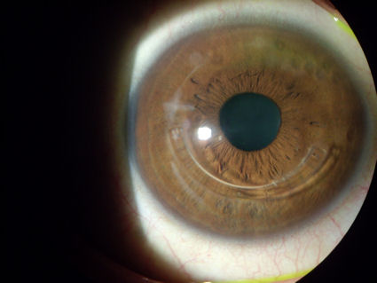post-LASIK ectasia, crosslinking, INTACS, epithelial ingrowth