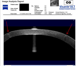 deep incision RK (radial keratotomy)
