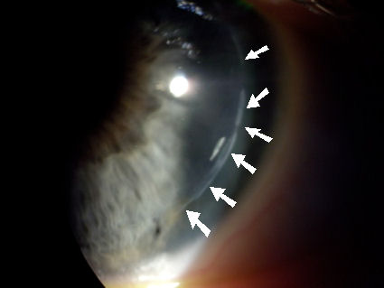 epithelial ingrowth along LASIK flap margin
