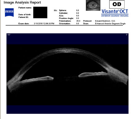 healthy unoperated cornea