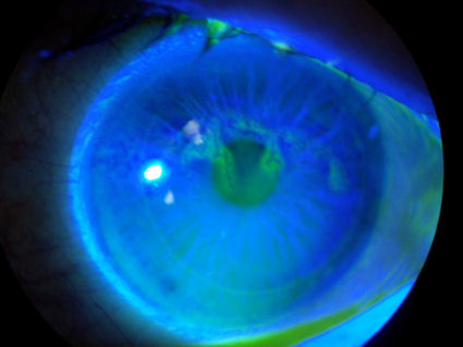 post-LASIK herpes keratitis