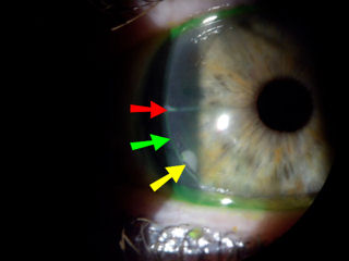 Patient has epithelial ingrowth following 2 RK and 2 LASIK surgeries