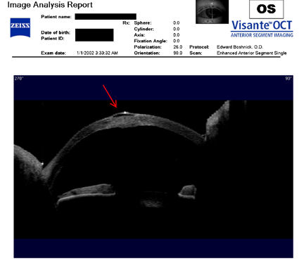 LASIK flap separating from cornea