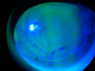 tear break up 2 seconds