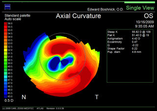 corneal ectasia after LASIK