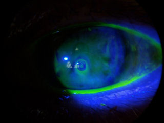 post RK bullous keratopathy