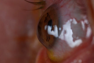 post RK post LASIK ectasia