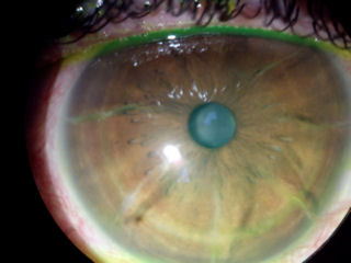 post RK post LASIK corneal neovascularization