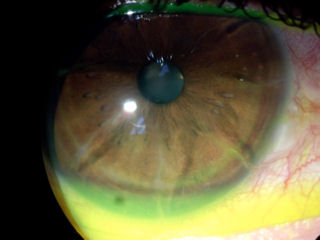 post RK post LASIK corneal neovascularization