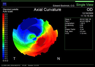 topography of post-LASIK cornea with ectasia