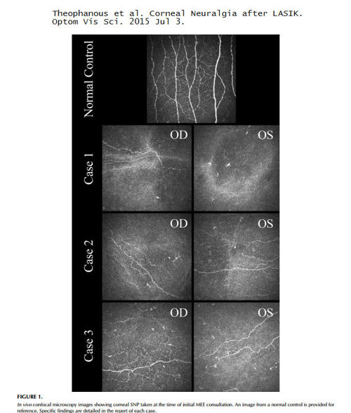 corneal nerves damaged by LASIK