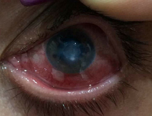 LASIK infection