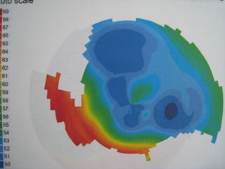2 RK procedures and 2 LASIK procedures