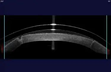 Файл из архива RKSurvivors: sclerallens-rkcornea_med.jpeg