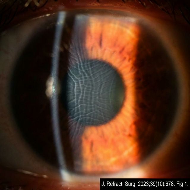 Микрострии кэпа после операции SMILE (ретроиллюминация). Видны тонкие параллельные складки из-за провисания кэпа.