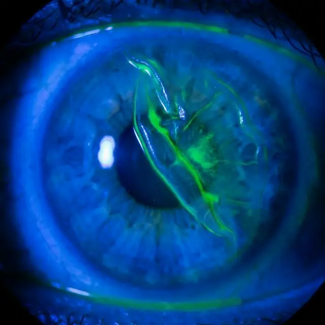 Макрофотография смещенного роговичного лоскута после LASIK при окрашивании флуоресцеином.