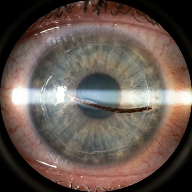 Инородное тело под микроскопом